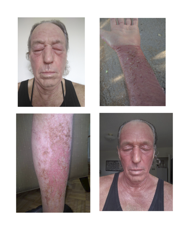 Four photographs showing facial swelling and severe skin symptoms