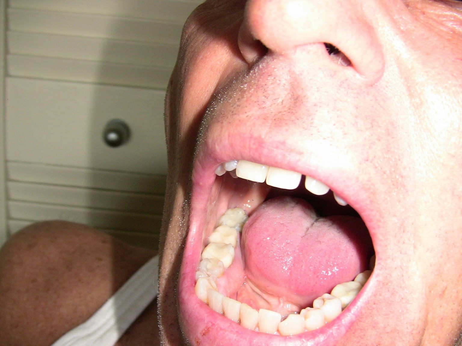 Teeth after replacement with composite fillings